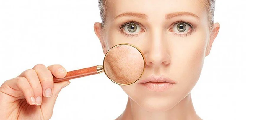 Melasma Treatment in Navi Mumbai