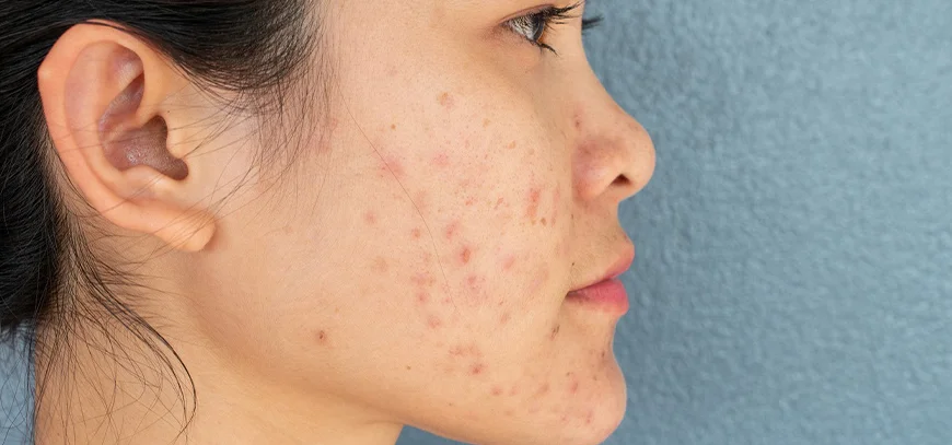 Best Acne Scar Treatment Navi Mumbai