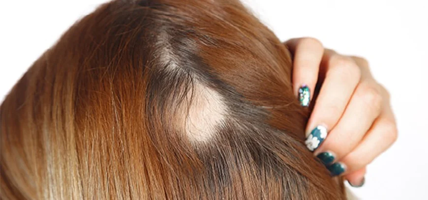 Alopecia Areata Treatment in Kharghar Navi Mumbai