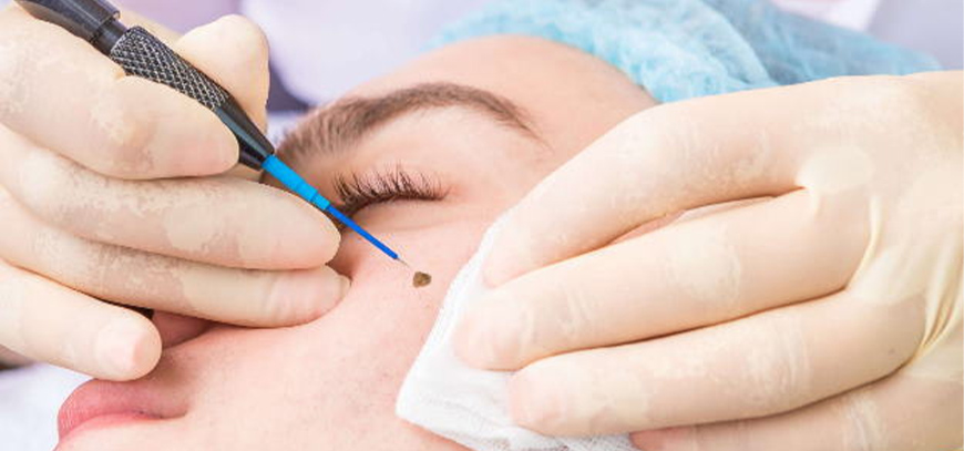 Best mole removal treatment in Kharghar Navi Mumbai